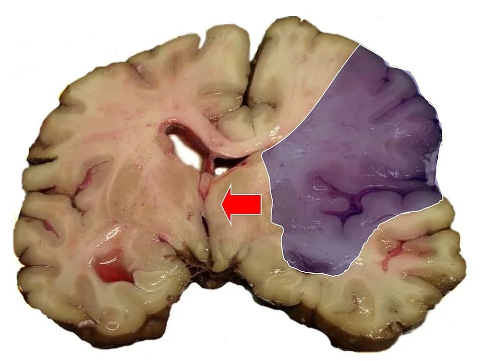 #2 Stroke (Cerebrovascular Disease) — Top 10 Leading Causes of Death Worldwide (WHO 2025)