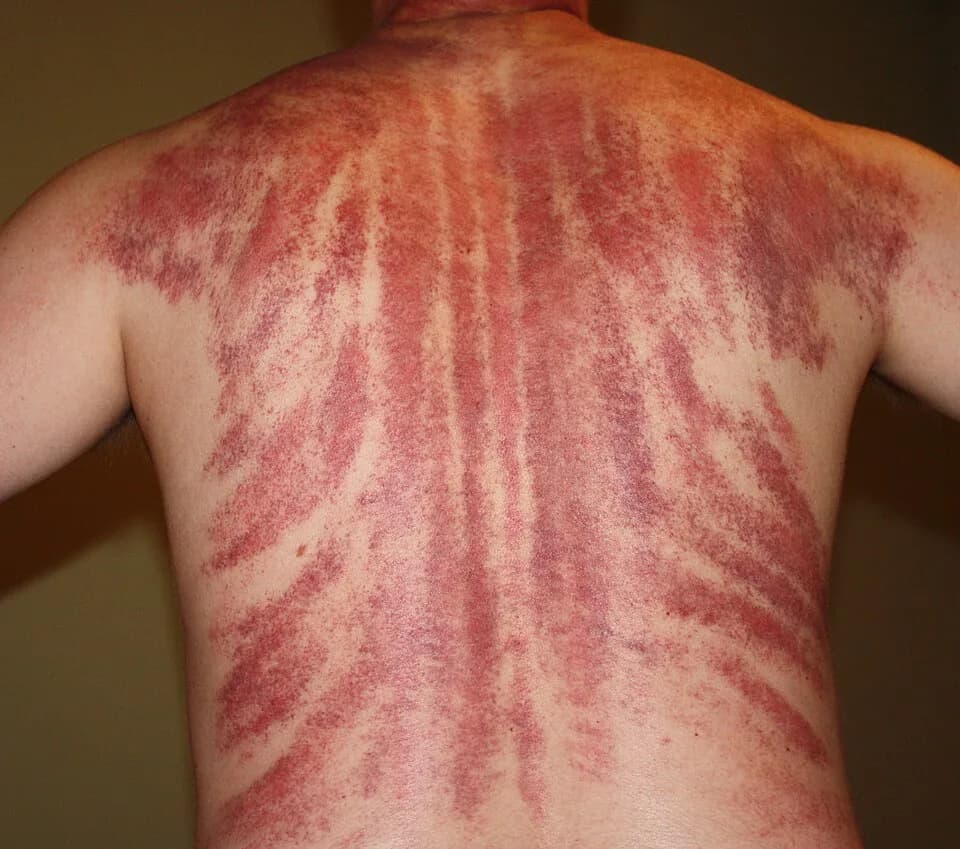 #3 Gua Sha — Top 10 Chinese Traditional Medicine and Wellness Practices Worth Trying