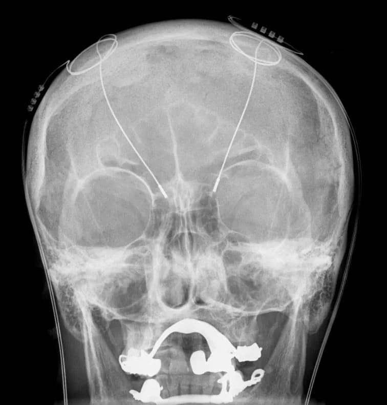 #9 Deep Brain Stimulation — Top 10 Best Neuroscience Breakthroughs