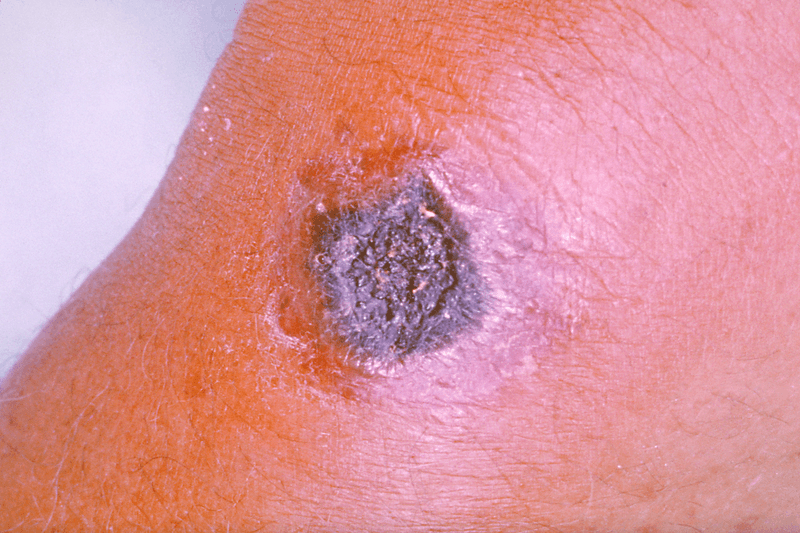 #8 Soviet Union's 1979 Sverdlovsk Anthrax Cover-Up — Top 10 Worst Pandemic Response Failures
