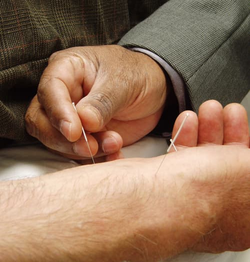 #1 Acupuncture — Top 10 Chinese Traditional Medicine and Wellness Practices Worth Trying