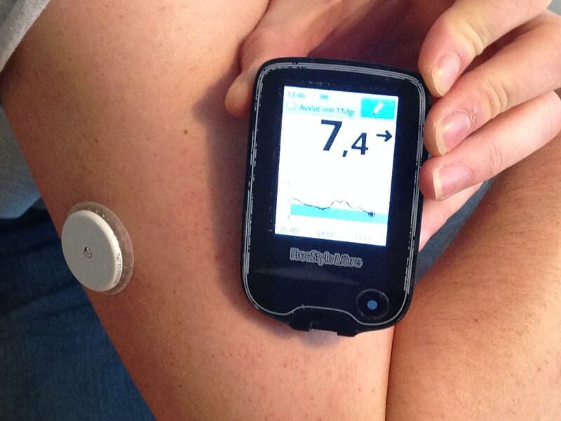 #3 Continuous Glucose Monitoring AI — Top 10 Most Impactful AI Applications in Healthcare 2025