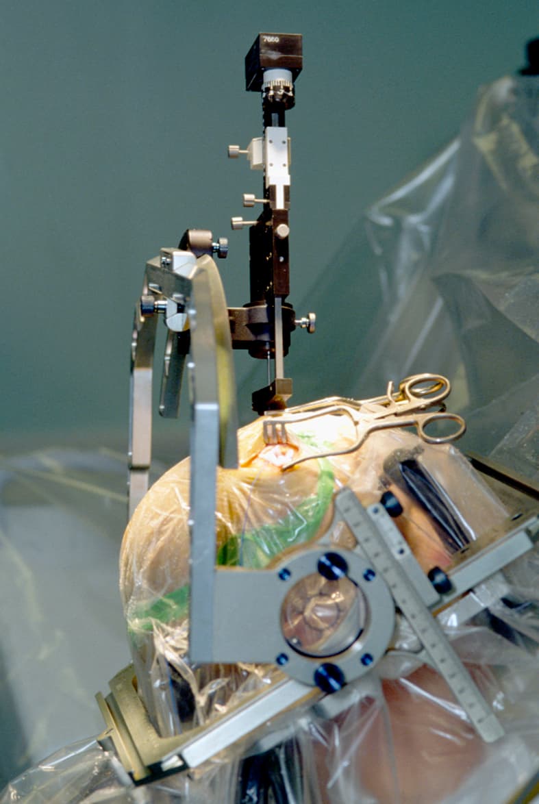 #9 Deep Brain Stimulation — Top 10 Science Experiments That Sound Like Science Fiction