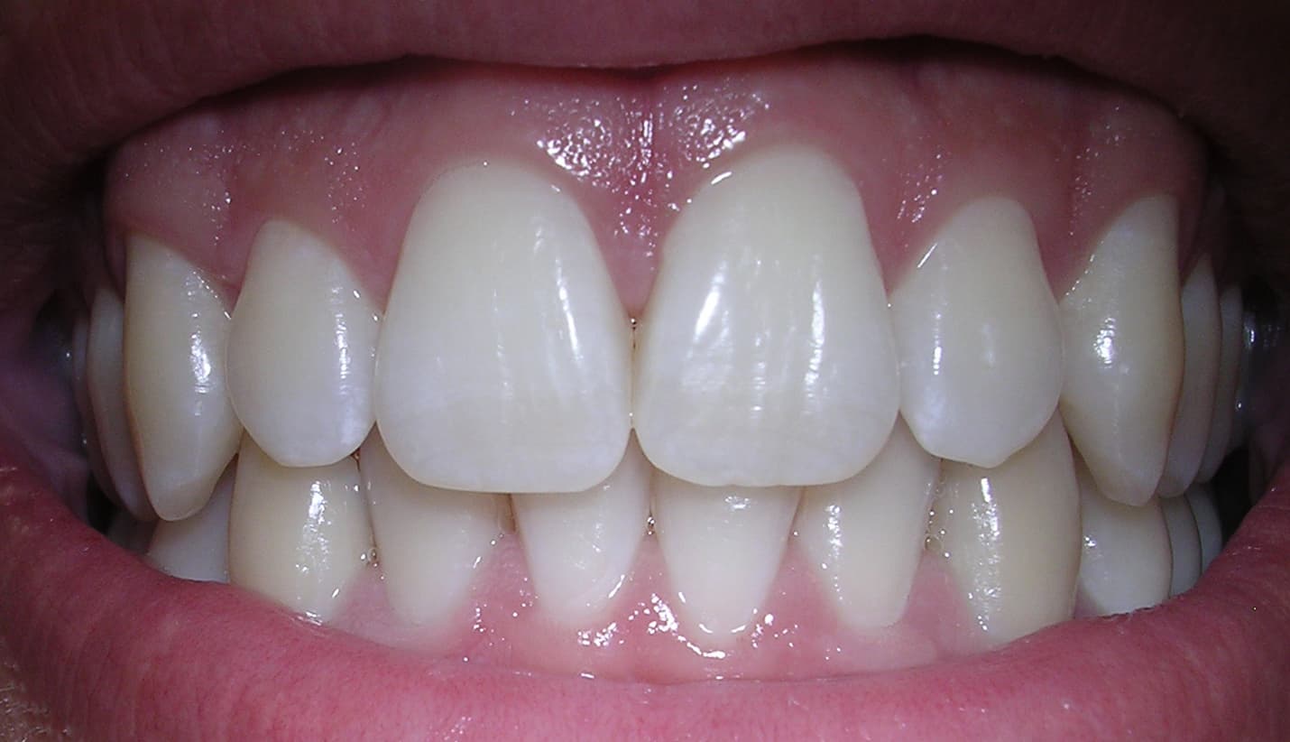 #3 Teeth Falling Out — Top 10 Most Common Dreams and What They Mean