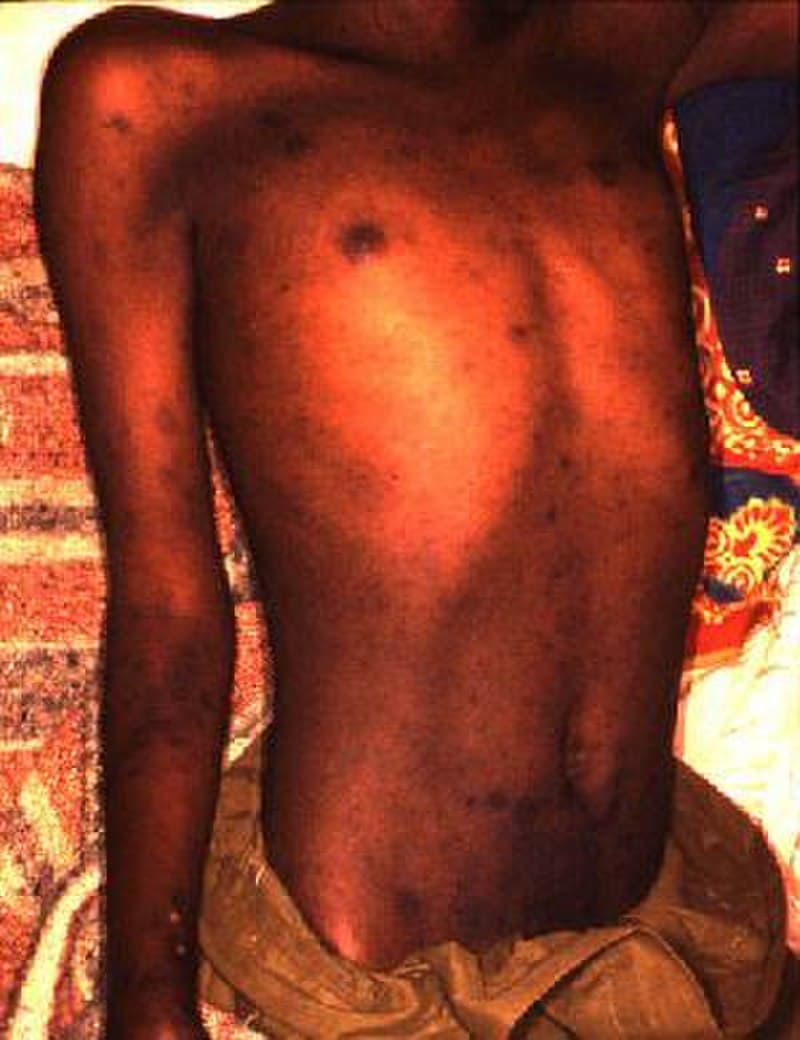 #9 Typhus — The Soldier's Disease — Top 10 Deadliest Pandemics in Human History — The Diseases That Reshaped Civilization