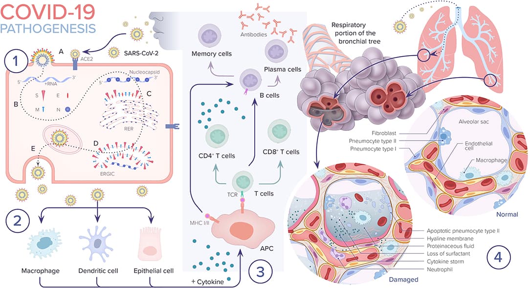 #4 Lower Respiratory Infections — Top 10 Leading Causes of Death Worldwide (WHO 2025)