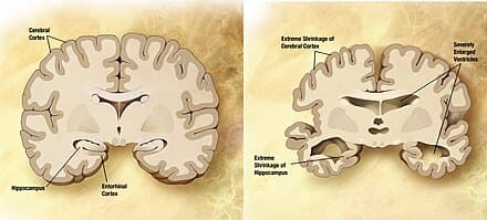 #7 Alzheimer's Disease and Other Dementias — Top 10 Leading Causes of Death Worldwide (WHO 2025)