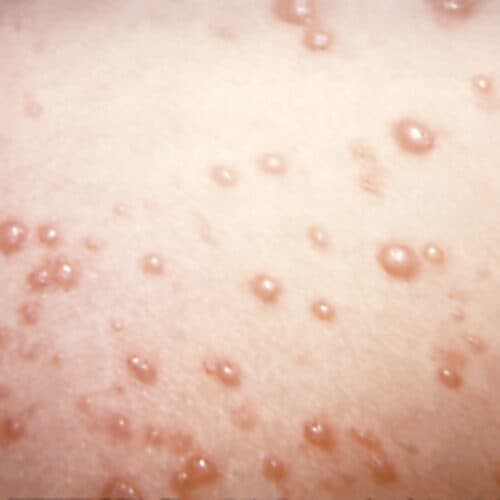 #8 In rare chickenpox case, itchy blisters mushroom into large, rubbery nodules — Top 10 Ars Technica — Latest — April 25, 2026