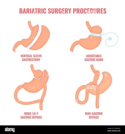 #7 Bariatric Surgery (Sleeve Gastrectomy / Gastric Bypass) — Top 10 GLP-1 Alternatives and Next-Generation Weight Loss Treatments of 2026