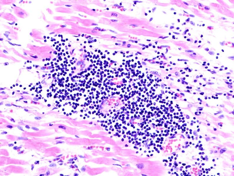#9 Myocarditis Risk in Young Males Post-mRNA Vaccination — Top 10 Most Debated Vaccine Topics in 2026
